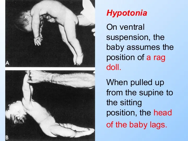 Hypotonia On ventral suspension, the baby assumes the position of