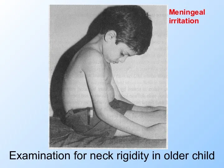 Examination for neck rigidity in older child Meningeal irritation