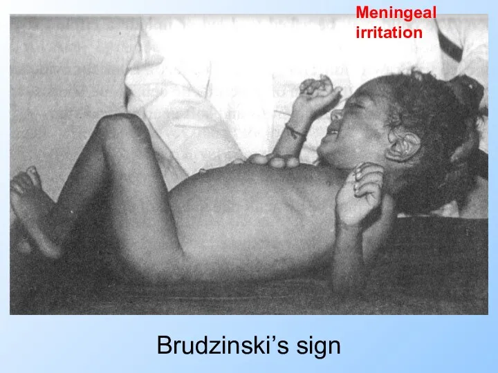 Brudzinski’s sign Meningeal irritation
