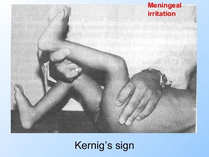 Kernig’s sign Meningeal irritation