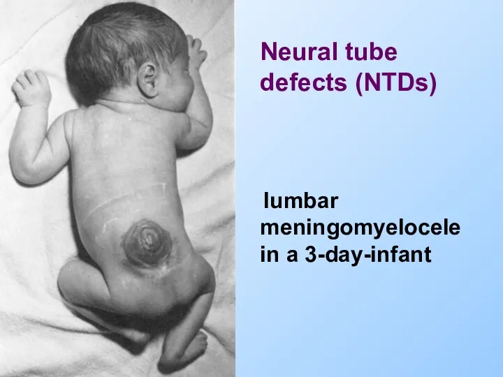 lumbar meningomyelocele in a 3-day-infant Neural tube defects (NTDs)