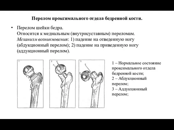 Перелом проксимального отдела бедренной кости. Перелом шейки бедра. Относится к