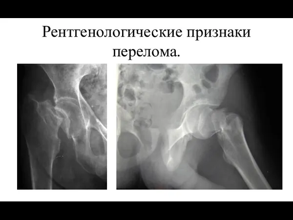 Рентгенологические признаки перелома.