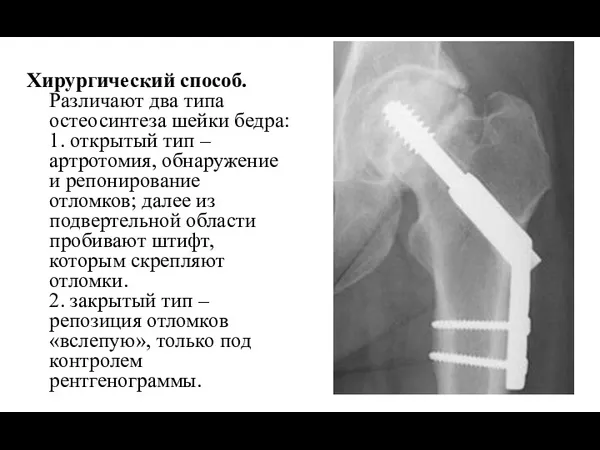 Хирургический способ. Различают два типа остеосинтеза шейки бедра: 1. открытый