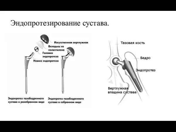 Эндопротезирование сустава.