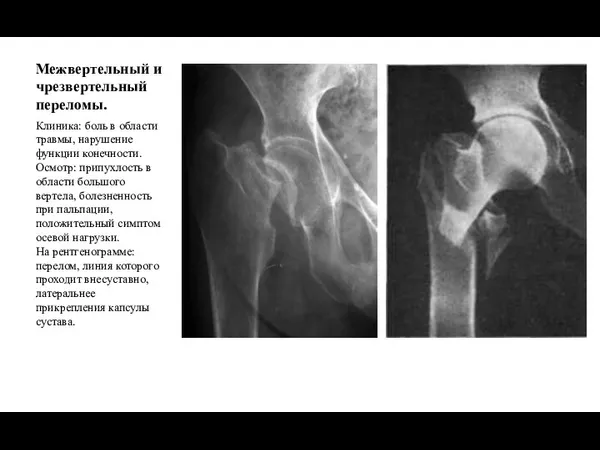 Межвертельный и чрезвертельный переломы. Клиника: боль в области травмы, нарушение