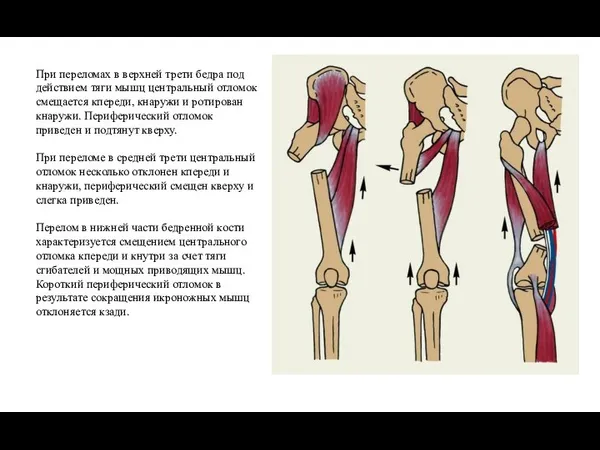 При переломах в верхней трети бедра под действием тяги мышц