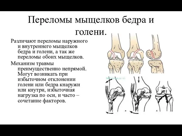 Переломы мыщелков бедра и голени. Различают переломы наружного и внутреннего