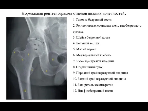 Нормальная рентгенограмма отделов нижних конечностей. 1. Головка бедренной кости 2.