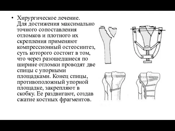 Хирургическое лечение. Для достижения максимально точного сопоставления отломков и плотного