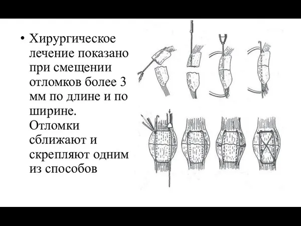 Хирургическое лечение показано при смещении отломков более 3 мм по