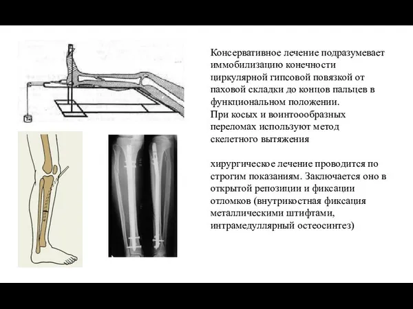 Консервативное лечение подразумевает иммобилизацию конечности циркулярной гипсовой повязкой от паховой