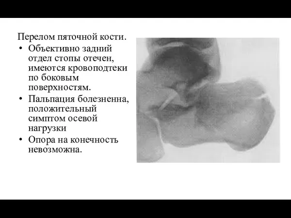 Перелом пяточной кости. Объективно задний отдел стопы отечен, имеются кровоподтеки