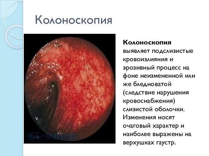 Колоноскопия Колоноскопия выявляет подслизистые кровоизлияния и эрозивный процесс на фоне