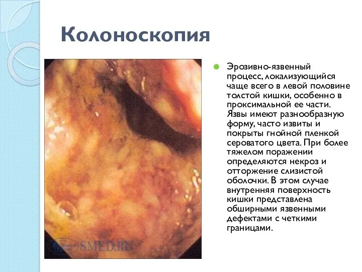 Колоноскопия Эрозивно-язвенный процесс, локализующийся чаще всего в левой половине толстой