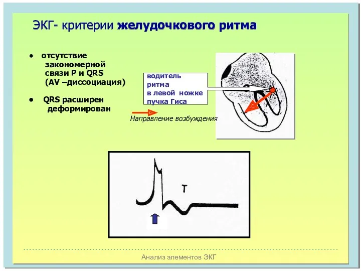 Анализ элементов ЭКГ ЭКГ- критерии желудочкового ритма водитель ритма в левой ножке пучка