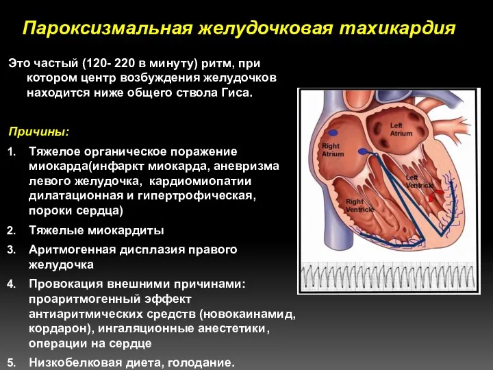 Пароксизмальная желудочковая тахикардия Это частый (120- 220 в минуту) ритм, при котором центр