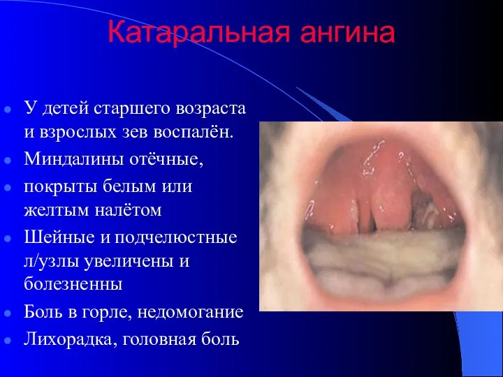 Катаральная ангина У детей старшего возраста и взрослых зев воспалён.