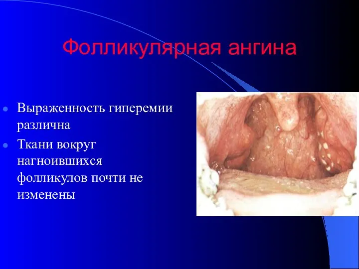 Фолликулярная ангина Выраженность гиперемии различна Ткани вокруг нагноившихся фолликулов почти не изменены