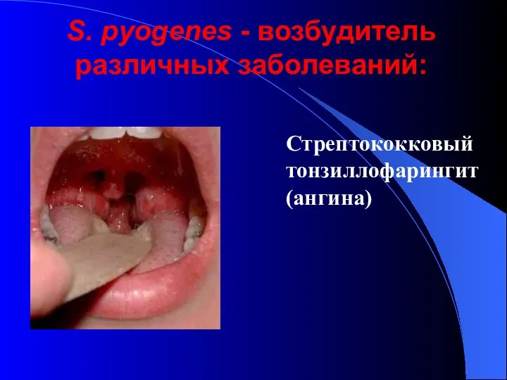 S. pyogenes - возбудитель различных заболеваний: Стрептококковый тонзиллофарингит (ангина)