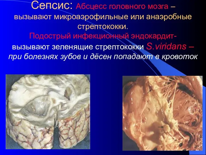 Сепсис: Абсцесс головного мозга – вызывают микроаэрофильные или анаэробные стрептококки.