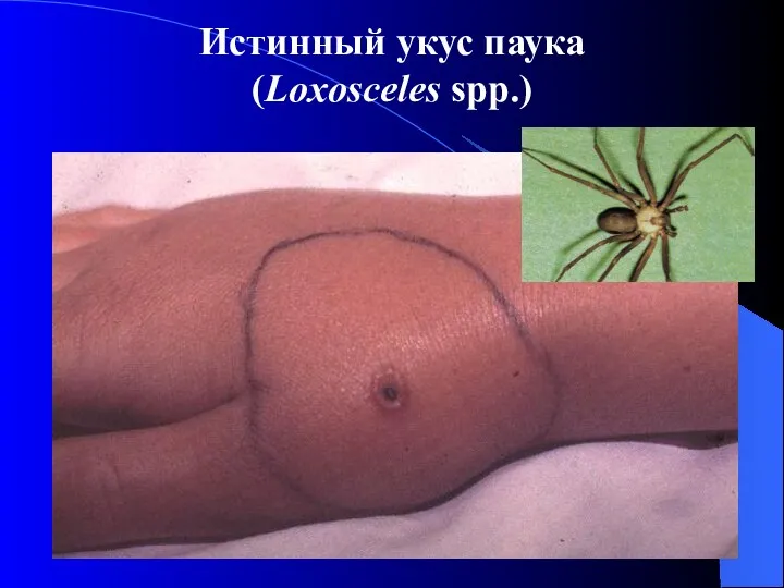Истинный укус паука (Loxosceles spp.)