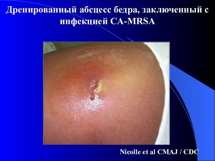 Nicolle et al CMAJ / CDC Дренированный абсцесс бедра, заключенный с инфекцией CA-MRSA