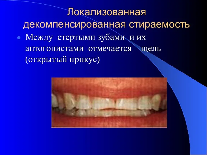 Локализованная декомпенсированная стираемость Между стертыми зубами и их антогонистами отмечается щель (открытый прикус)