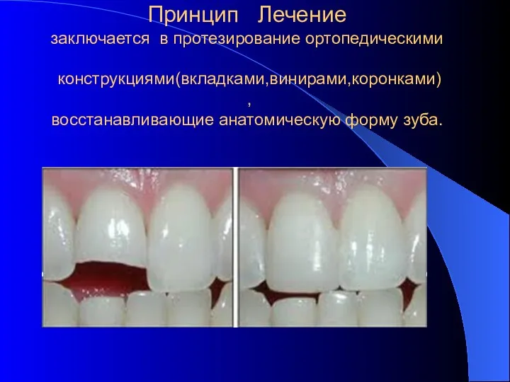 Принцип Лечение заключается в протезирование ортопедическими конструкциями(вкладками,винирами,коронками) , восстанавливающие анатомическую форму зуба.