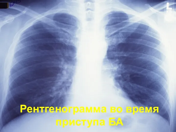 Рентгенограмма во время приступа БА