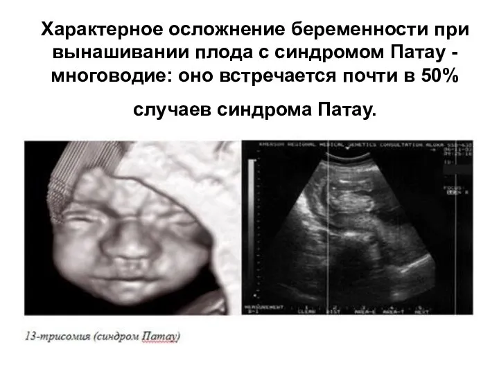 Характерное осложнение беременности при вынашивании плода с синдромом Патау -