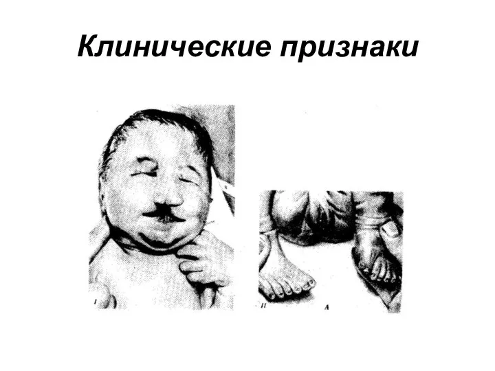 Клинические признаки