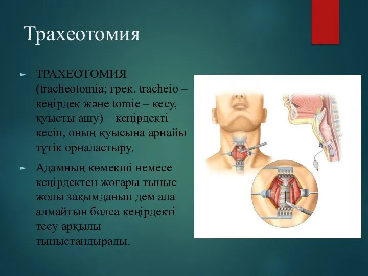 Трахеотомия ТРАХЕОТОМИЯ (tracheotomіa; грек. tracheіo – кеңірдек және tomіe –