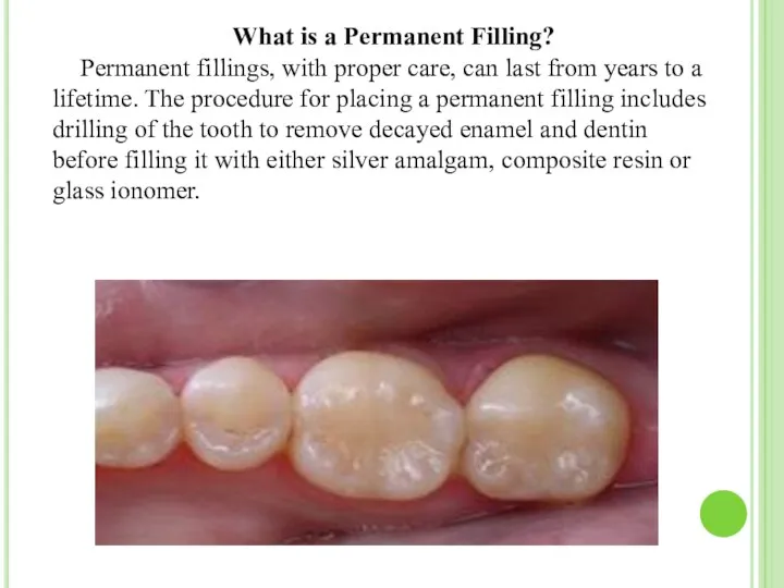 What is a Permanent Filling? Permanent fillings, with proper care,