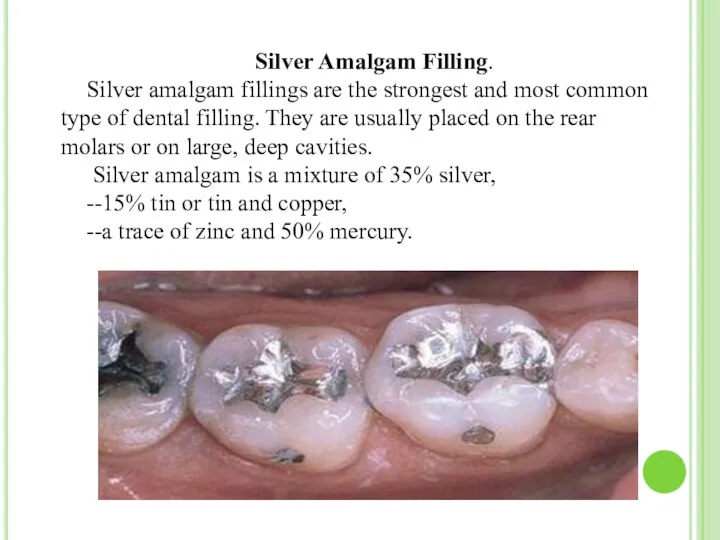 Silver Amalgam Filling. Silver amalgam fillings are the strongest and