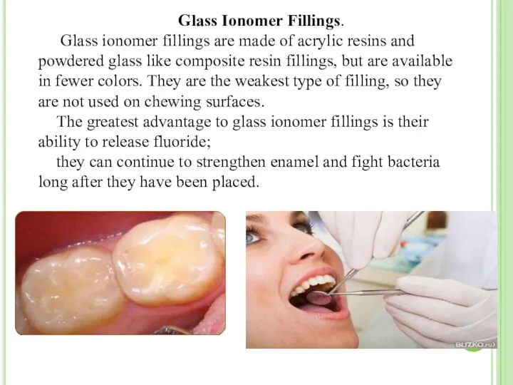 Glass Ionomer Fillings. Glass ionomer fillings are made of acrylic