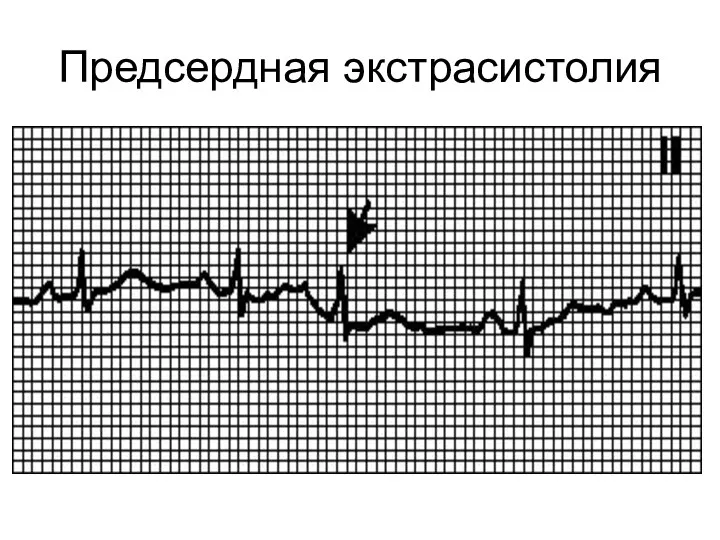 Предсердная экстрасистолия