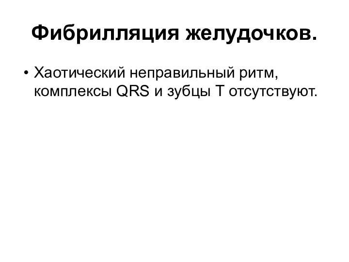 Фибрилляция желудочков. Хаотический неправильный ритм, комплексы QRS и зубцы T отсутствуют.