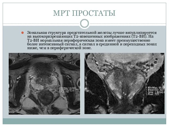 МРТ ПРОСТАТЫ Зональная структура предстательной железы лучше визуализируется на высокоразрешающих Т2-взвешенных изображениях (Т2-ВИ).