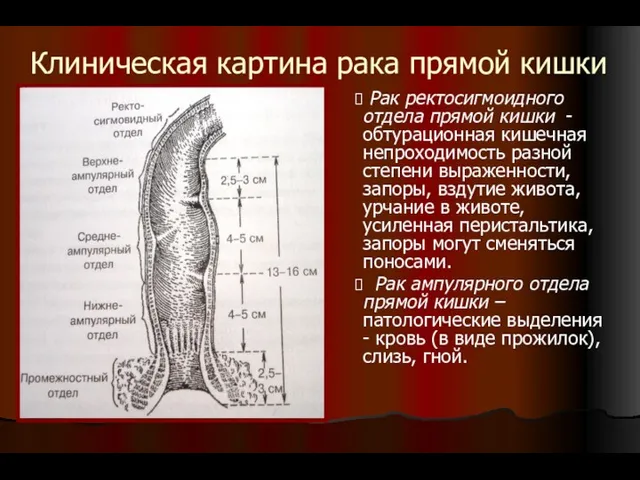 Клиническая картина рака прямой кишки Рак ректосигмоидного отдела прямой кишки - обтурационная кишечная