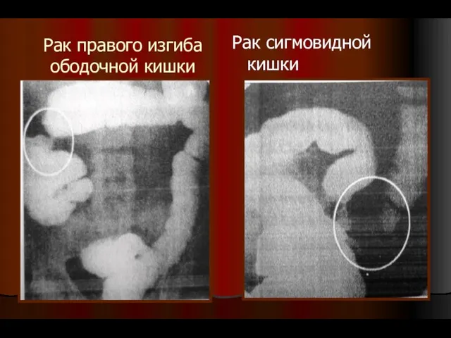 Рак правого изгиба ободочной кишки Рак сигмовидной кишки