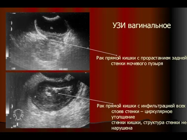 УЗИ вагинальное Рак прямой кишки с инфильтрацией всех слоев стенки