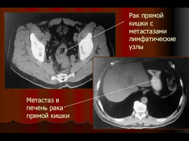Рак прямой кишки с метастазами лимфатические узлы Метастаз в печень рака прямой кишки