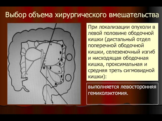 Выбор объема хирургического вмешательства