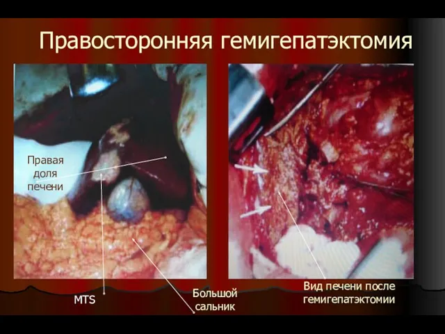Правосторонняя гемигепатэктомия Правая доля печени MTS Большой сальник Вид печени после гемигепатэктомии