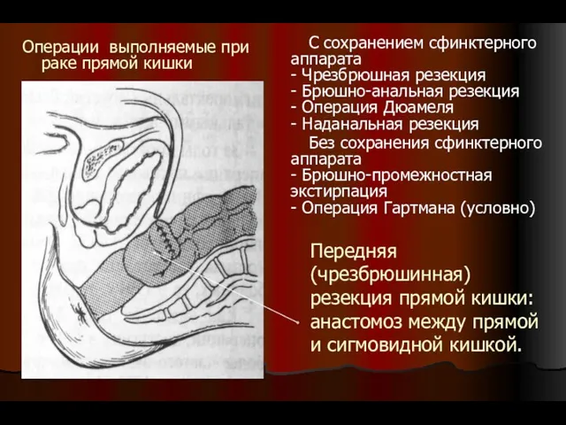 Передняя (чрезбрюшинная) резекция прямой кишки: анастомоз между прямой и сигмовидной кишкой. С сохранением