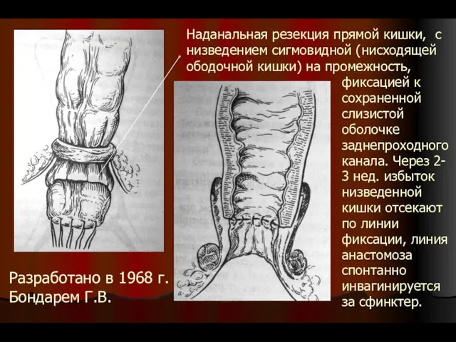 Наданальная резекция прямой кишки, с низведением сигмовидной (нисходящей ободочной кишки) на промежность, фиксацией