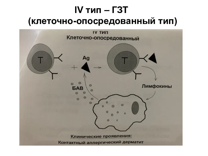 IV тип – ГЗТ (клеточно-опосредованный тип)