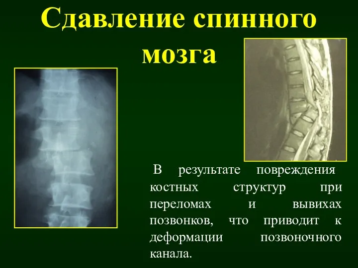 Сдавление спинного мозга В результате повреждения костных структур при переломах и вывихах позвонков,