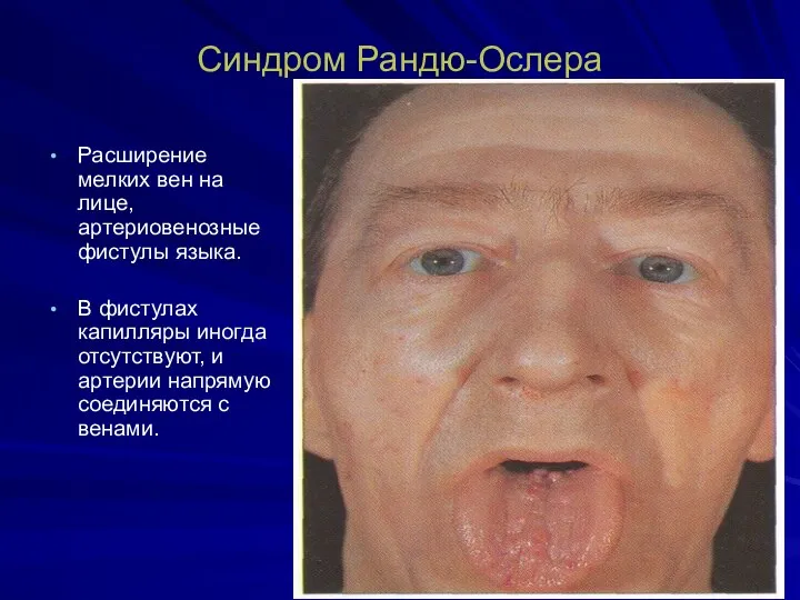 Синдром Рандю-Ослера Расширение мелких вен на лице, артериовенозные фистулы языка.